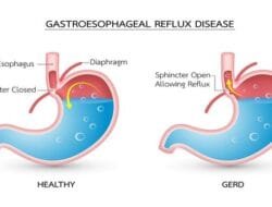 Pernah Mengalami GERD? Kenali Penyebab, Risiko, dan Cara Mengatasinya