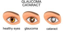 Perbedaan Glaukoma dan Katarak Penyebab Hilangnya Penglihatan